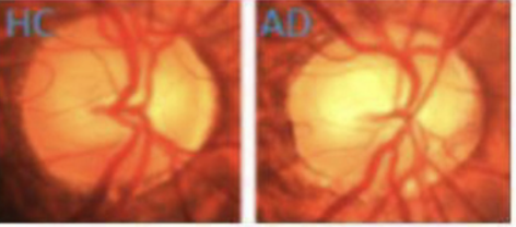 Retinal fundus photograph