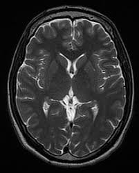 Axial brain MRI slice